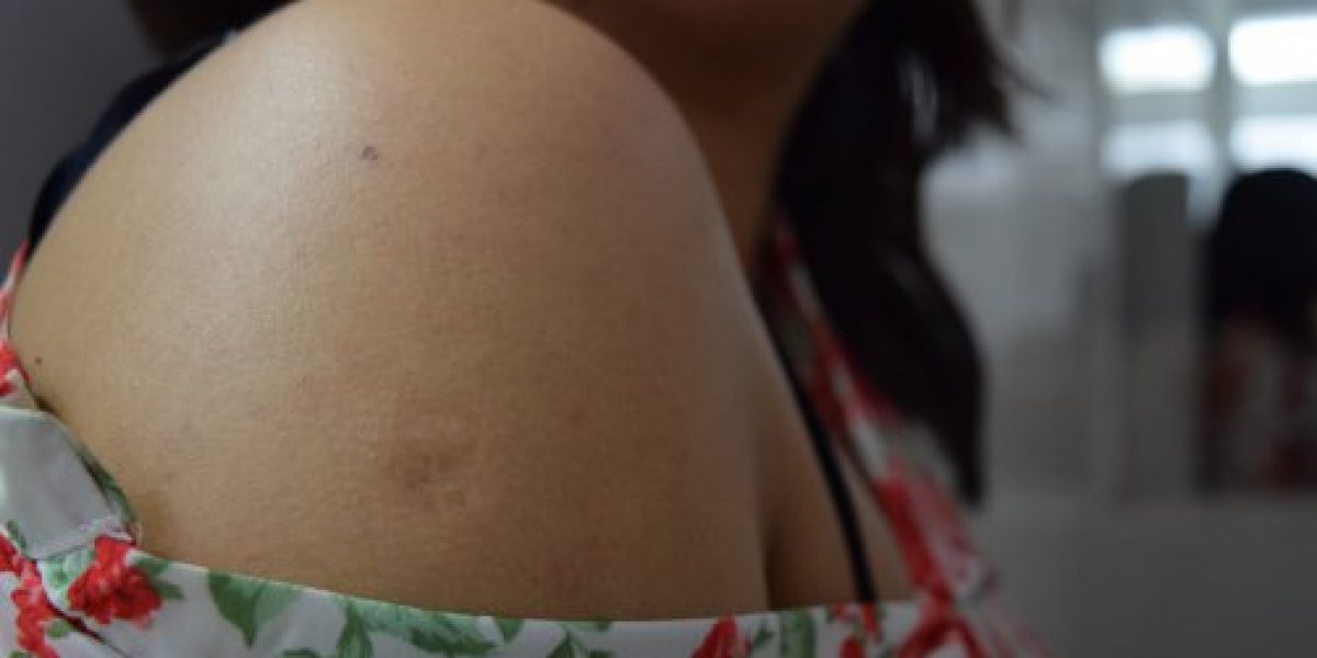 marca brazo vacuna viruela